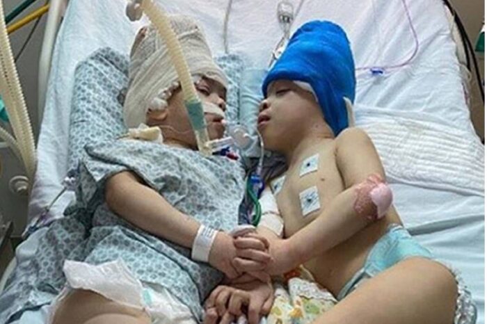 British Asian neurosurgeon successfully separates Brazilian conjoined twins