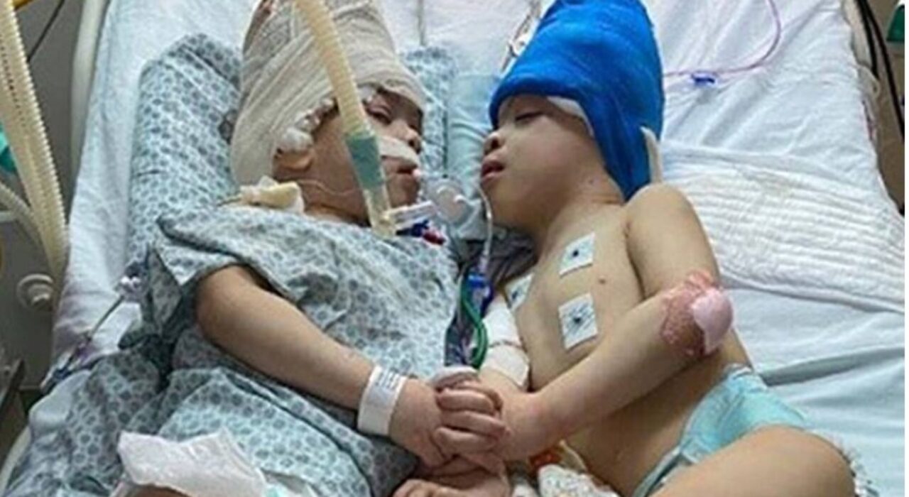 1 A British Asian neurosurgeon successfully separates Brazilian conjoined twins